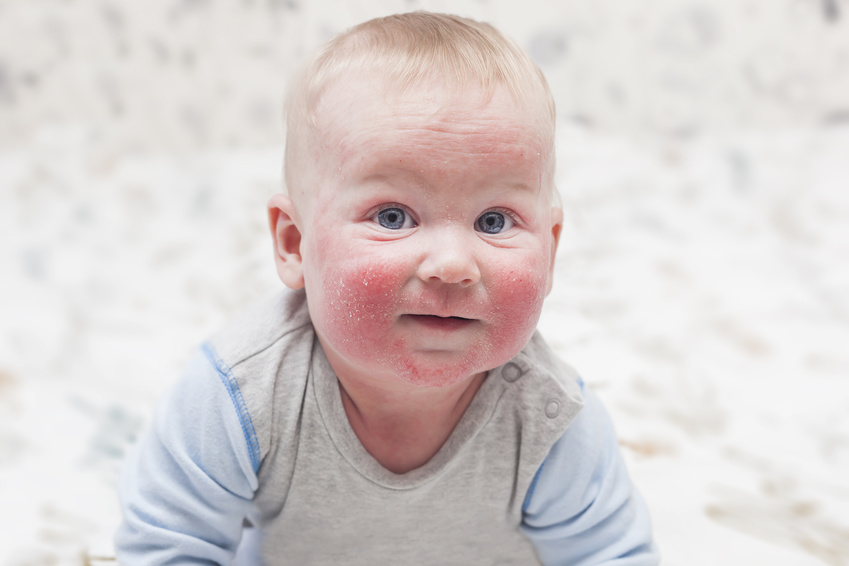 bébé avec eczéma sur le visage