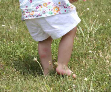 piqûre d'insecte enfant